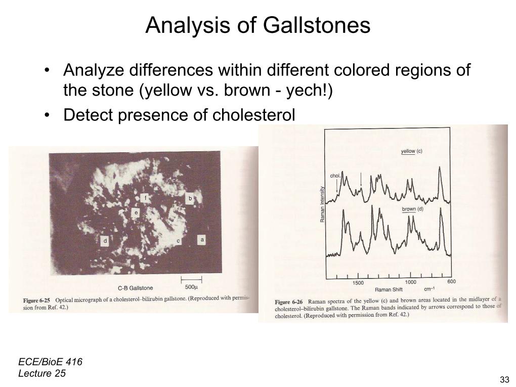 Analysis of Gallstones