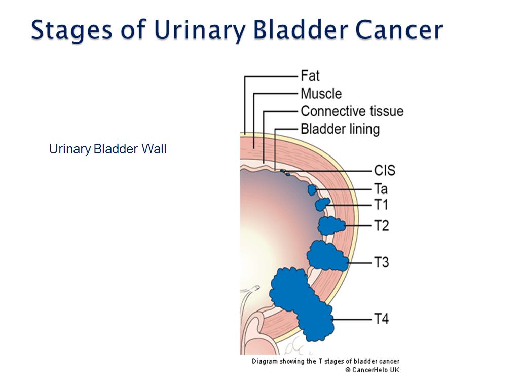 Stages of Urinary Bladder Cancer
