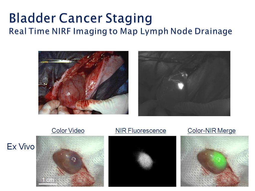 Bladder Cancer Staging Real Time NIRF Imaging to Map Lymph Node Drainage
