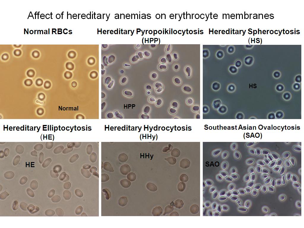 Affect of hereditary anemias on erythrocyte membranes