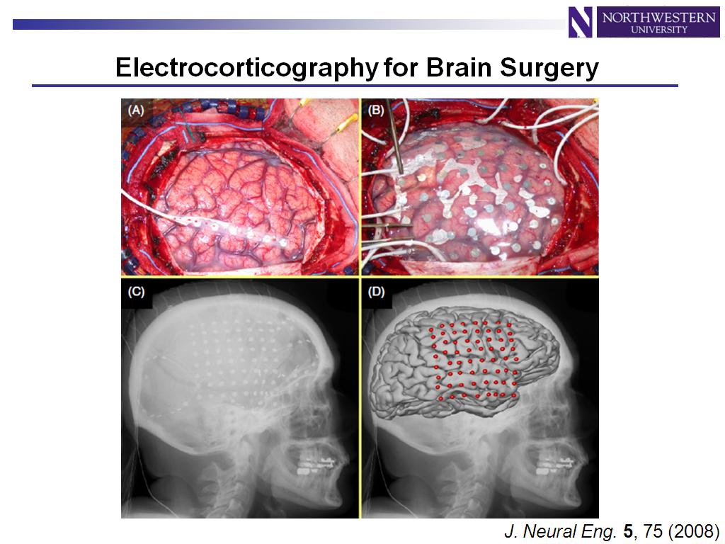 Electrocorticography for Brain Surgery