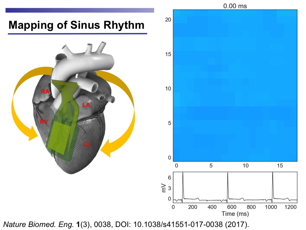 Mapping of Sinus Rhythm