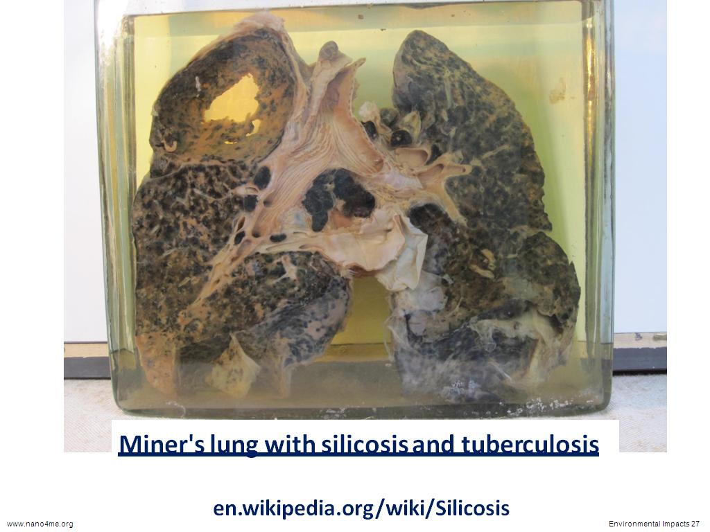 Miner's lung with silicosis and tuberculosis