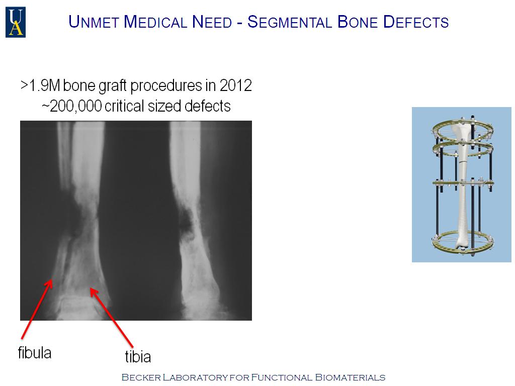 Unmet Medical Need - Segmental Bone Defects