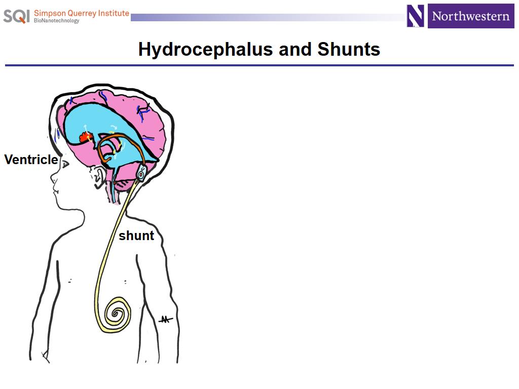 Hydrocephalus and Shunts
